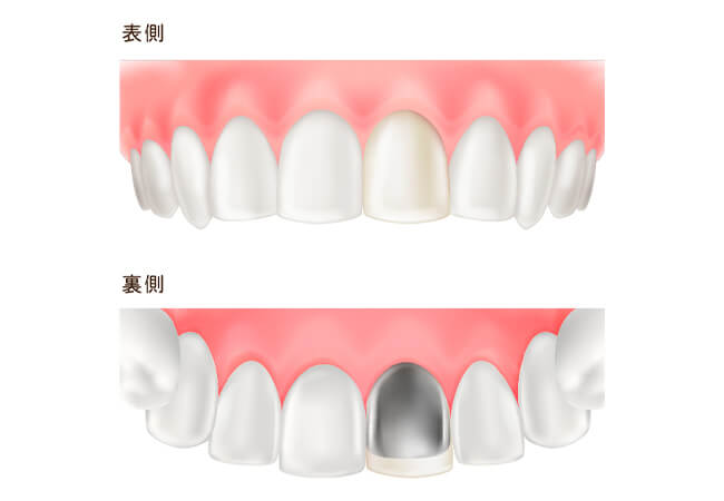 硬質レジン前装冠（前歯のみ）