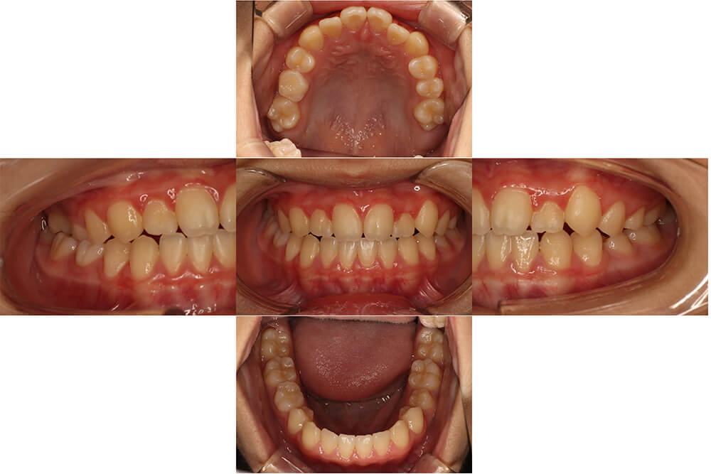 反対咬合 治療後